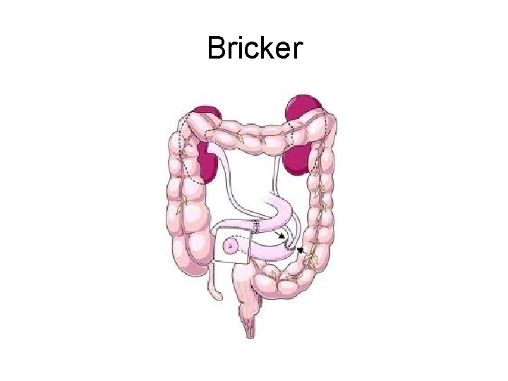 Bricker 