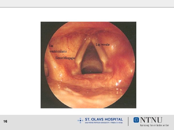 Lig. vocalis Lig. ventricularis Sinus Morgagni 16 
