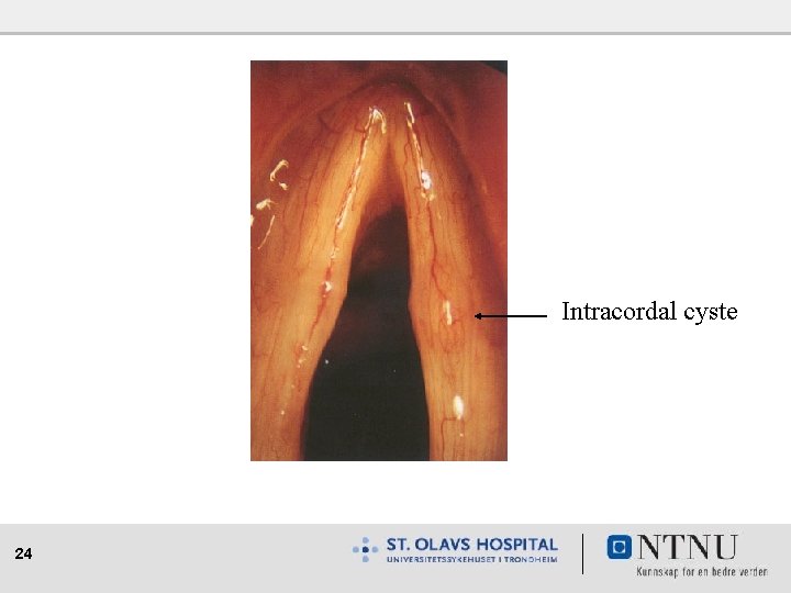 Intracordal cyste 24 