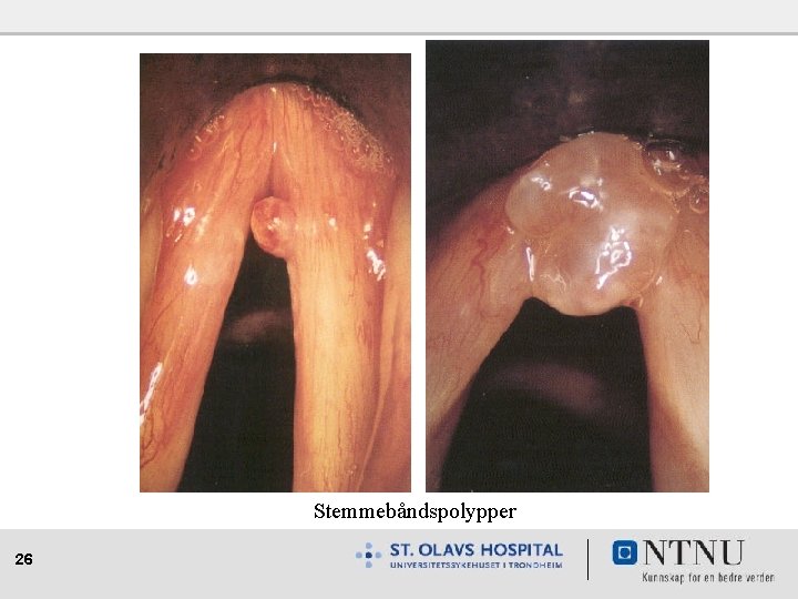 Stemmebåndspolypper 26 
