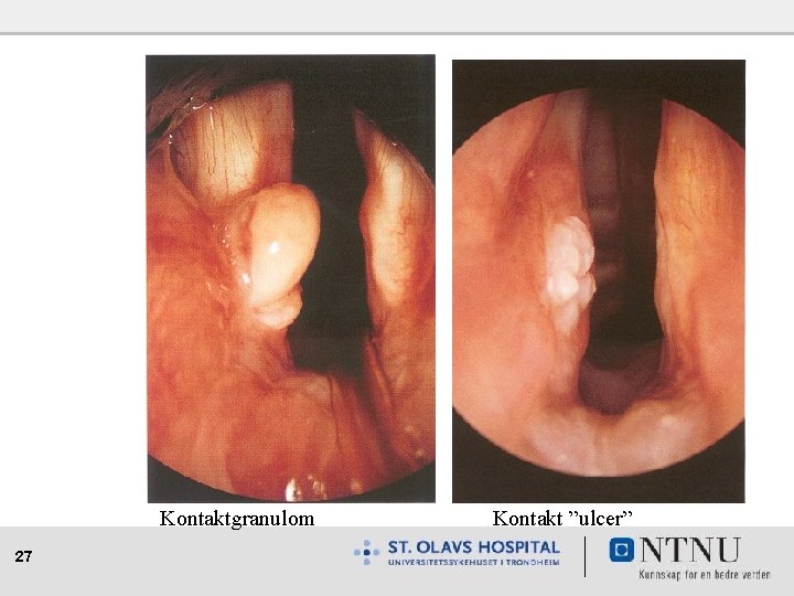 Kontaktgranulom 27 Kontakt ”ulcer” 