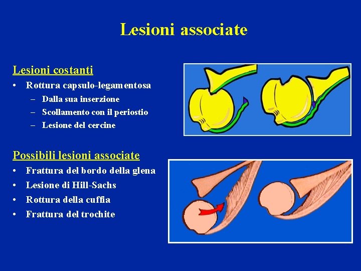 Lesioni associate Lesioni costanti • Rottura capsulo-legamentosa – Dalla sua inserzione – Scollamento con Lesioni associate Lesioni costanti • Rottura capsulo-legamentosa – Dalla sua inserzione – Scollamento con