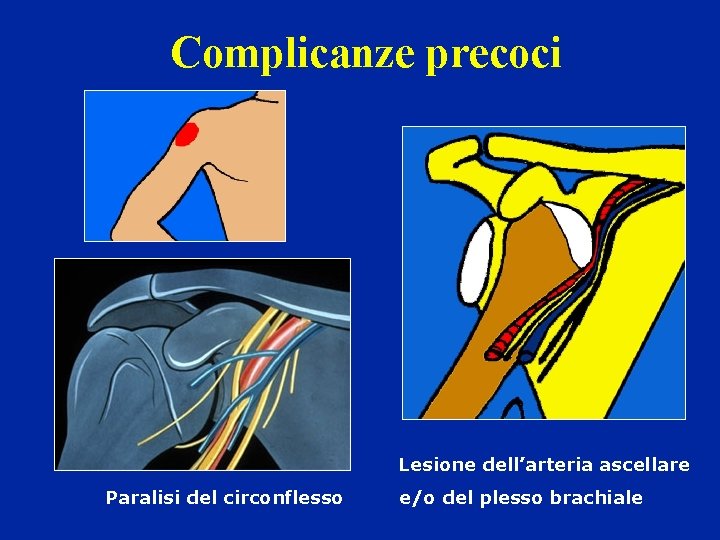 Complicanze precoci Lesione dell’arteria ascellare Paralisi del circonflesso e/o del plesso brachiale Complicanze precoci Lesione dell’arteria ascellare Paralisi del circonflesso e/o del plesso brachiale