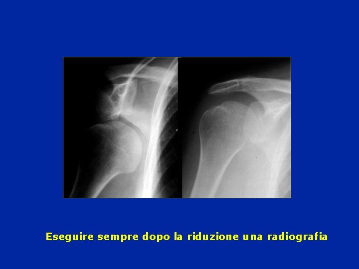 Eseguire sempre dopo la riduzione una radiografia Eseguire sempre dopo la riduzione una radiografia
