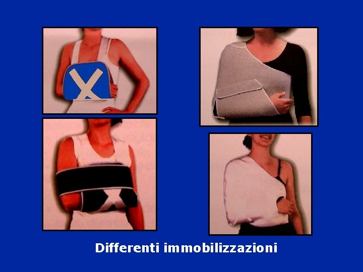 Differenti immobilizzazioni Differenti immobilizzazioni