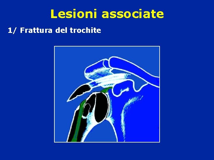 Lesioni associate 1/ Frattura del trochite Lesioni associate 1/ Frattura del trochite