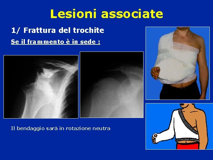Lesioni associate 1/ Frattura del trochite Se il frammento è in sede : Il Lesioni associate 1/ Frattura del trochite Se il frammento è in sede : Il
