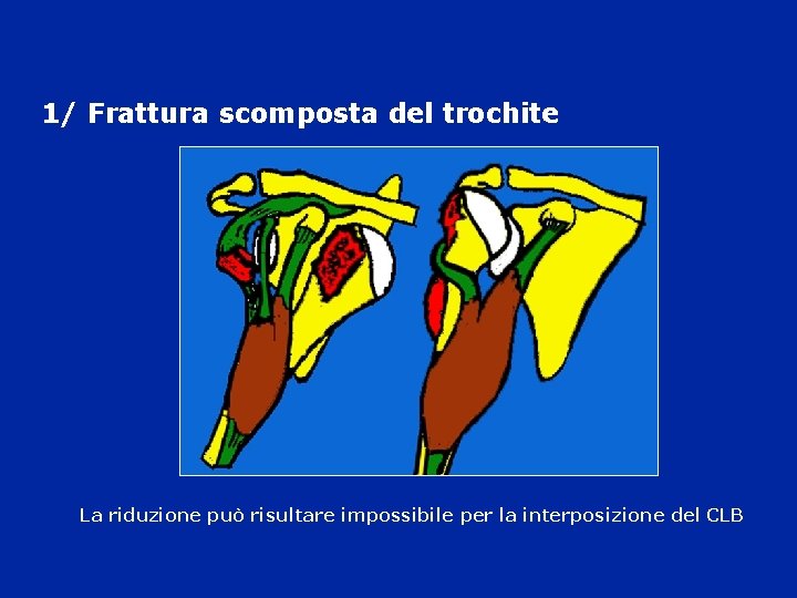 1/ Frattura scomposta del trochite La riduzione può risultare impossibile per la interposizione del 1/ Frattura scomposta del trochite La riduzione può risultare impossibile per la interposizione del