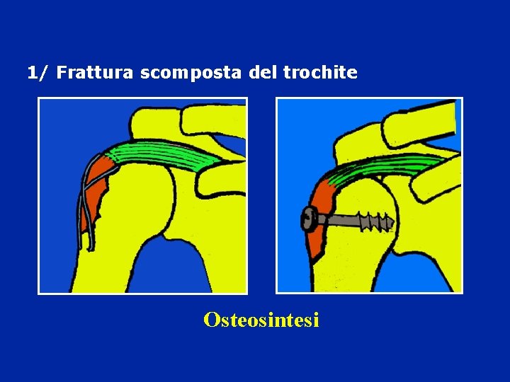 1/ Frattura scomposta del trochite Osteosintesi 1/ Frattura scomposta del trochite Osteosintesi