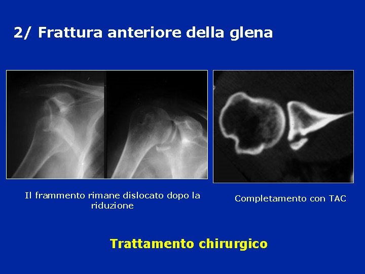 2/ Frattura anteriore della glena Il frammento rimane dislocato dopo la riduzione Completamento con 2/ Frattura anteriore della glena Il frammento rimane dislocato dopo la riduzione Completamento con