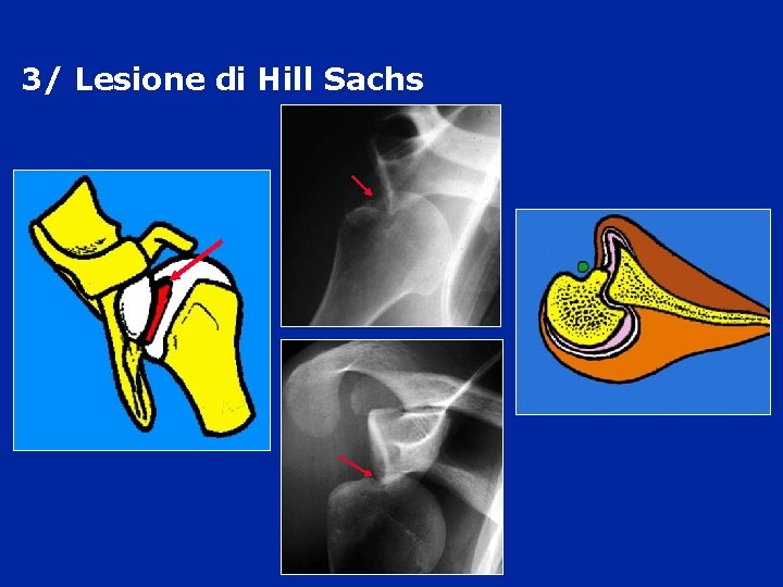 3/ Lesione di Hill Sachs 3/ Lesione di Hill Sachs