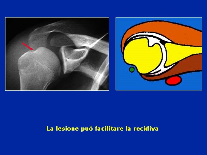 La lesione può facilitare la recidiva La lesione può facilitare la recidiva
