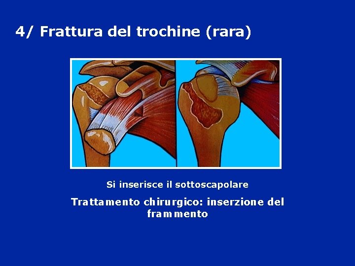 4/ Frattura del trochine (rara) Si inserisce il sottoscapolare Trattamento chirurgico: inserzione del frammento 4/ Frattura del trochine (rara) Si inserisce il sottoscapolare Trattamento chirurgico: inserzione del frammento