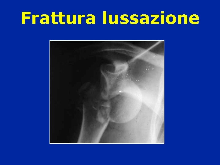 Frattura lussazione Frattura lussazione