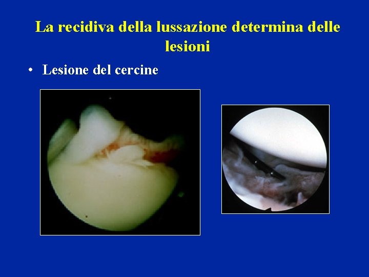 La recidiva della lussazione determina delle lesioni • Lesione del cercine La recidiva della lussazione determina delle lesioni • Lesione del cercine