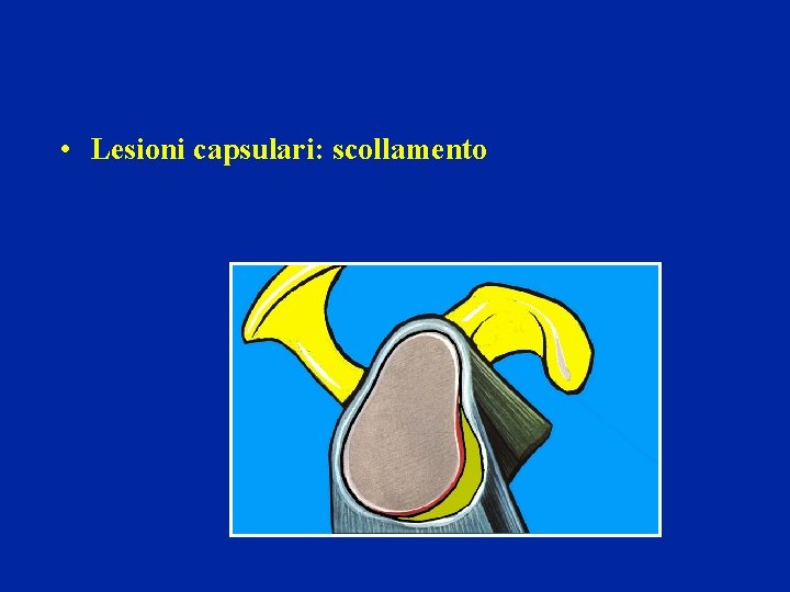 • Lesioni capsulari: scollamento • Lesioni capsulari: scollamento