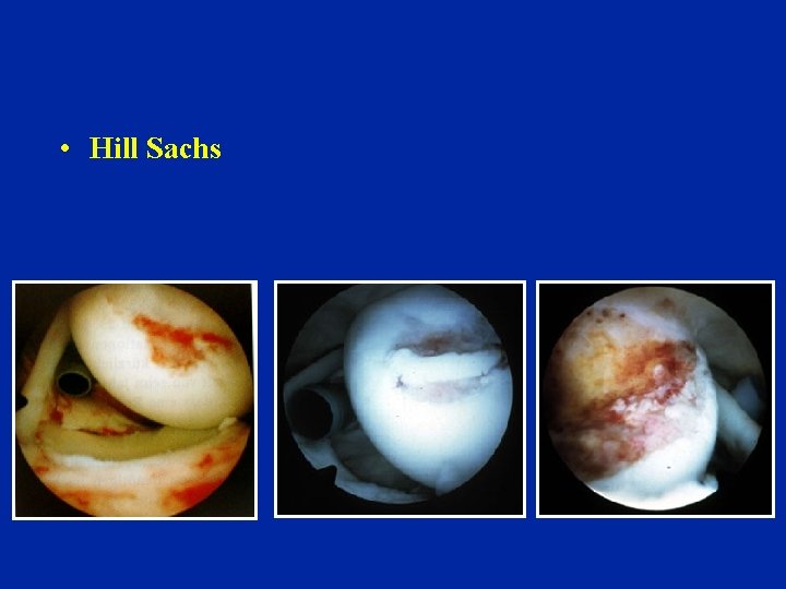 • Hill Sachs • Hill Sachs
