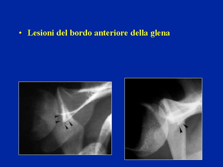 • Lesioni del bordo anteriore della glena • Lesioni del bordo anteriore della glena