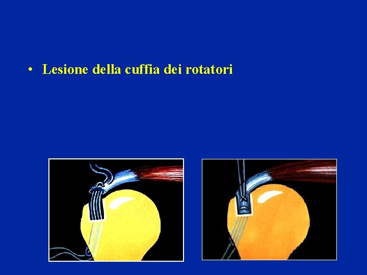 • Lesione della cuffia dei rotatori • Lesione della cuffia dei rotatori