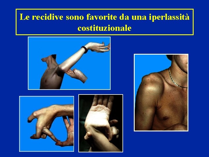 Le recidive sono favorite da una iperlassità costituzionale Le recidive sono favorite da una iperlassità costituzionale