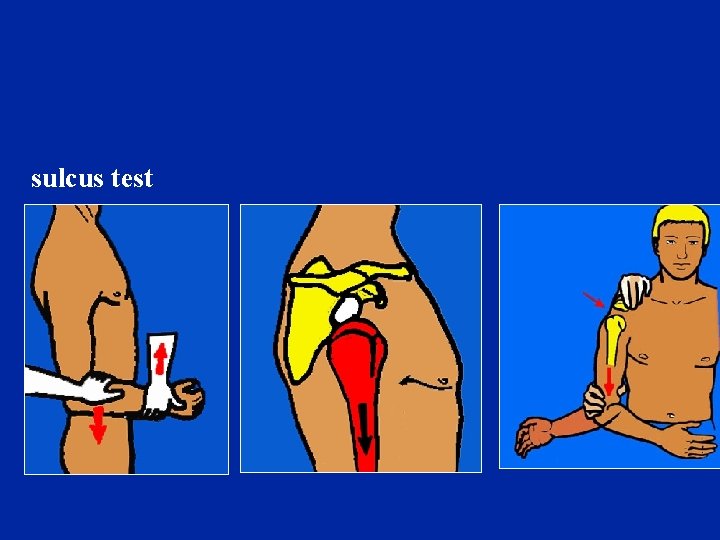sulcus test sulcus test