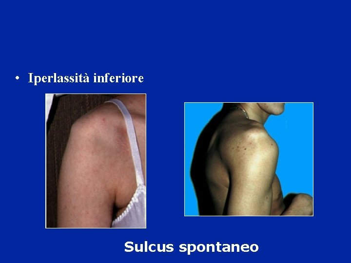 • Iperlassità inferiore Sulcus spontaneo • Iperlassità inferiore Sulcus spontaneo