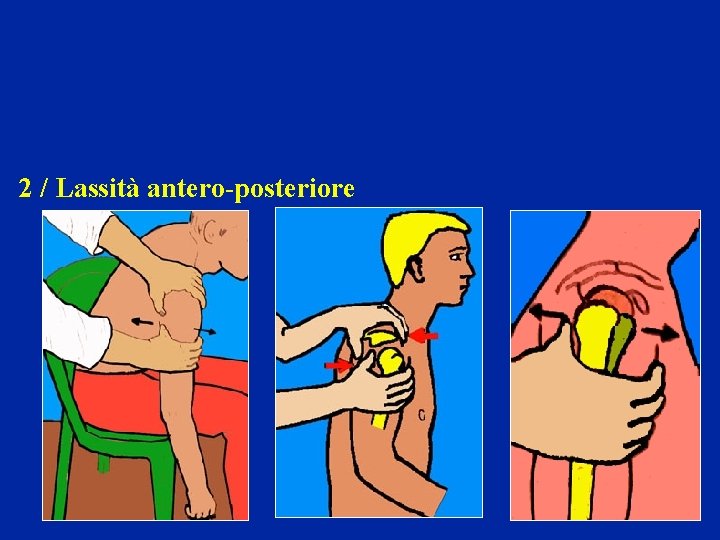 2 / Lassità antero-posteriore 2 / Lassità antero-posteriore