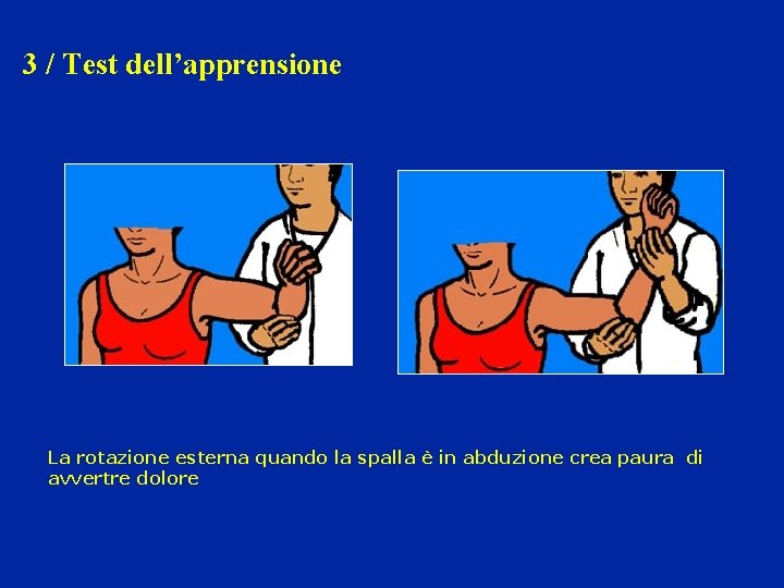 3 / Test dell’apprensione La rotazione esterna quando la spalla è in abduzione crea 3 / Test dell’apprensione La rotazione esterna quando la spalla è in abduzione crea