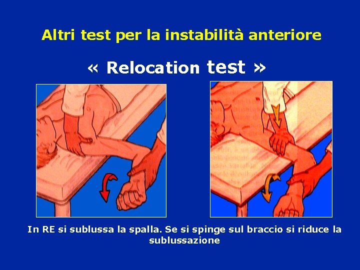 Altri test per la instabilità anteriore « Relocation test » In RE si sublussa Altri test per la instabilità anteriore « Relocation test » In RE si sublussa