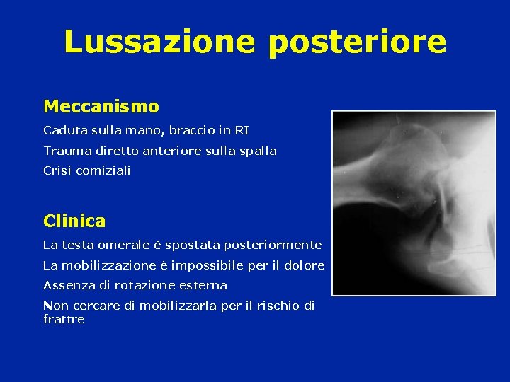 Lussazione posteriore Meccanismo Caduta sulla mano, braccio in RI Trauma diretto anteriore sulla spalla Lussazione posteriore Meccanismo Caduta sulla mano, braccio in RI Trauma diretto anteriore sulla spalla