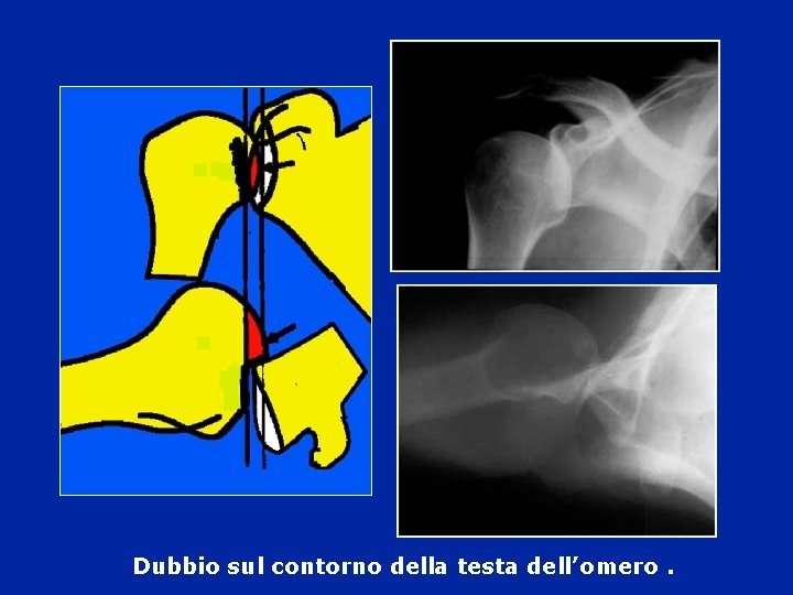 Dubbio sul contorno della testa dell’omero. Dubbio sul contorno della testa dell’omero.