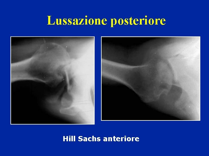 Lussazione posteriore Hill Sachs anteriore Lussazione posteriore Hill Sachs anteriore