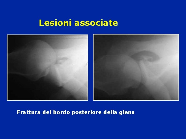 Lesioni associate Frattura del bordo posteriore della glena Lesioni associate Frattura del bordo posteriore della glena