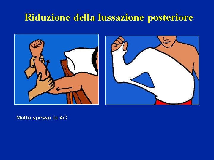 Riduzione della lussazione posteriore Molto spesso in AG Riduzione della lussazione posteriore Molto spesso in AG