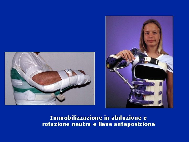 Immobilizzazione in abduzione e rotazione neutra e lieve anteposizione Immobilizzazione in abduzione e rotazione neutra e lieve anteposizione