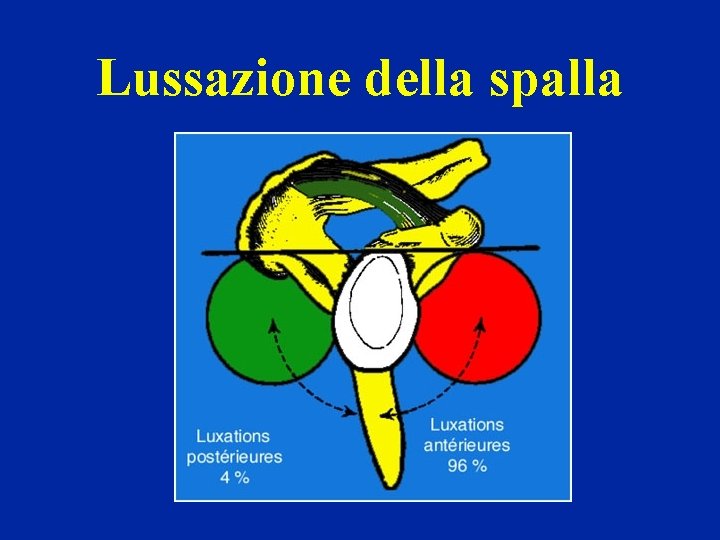 Lussazione della spalla Lussazione della spalla