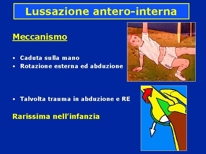 Lussazione antero-interna Meccanismo • Caduta sulla mano • Rotazione esterna ed abduzione • Talvolta Lussazione antero-interna Meccanismo • Caduta sulla mano • Rotazione esterna ed abduzione • Talvolta
