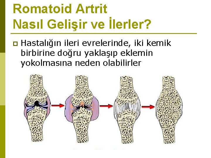 Romatoid Artrit Nasıl Gelişir ve İlerler? p Hastalığın ileri evrelerinde, iki kemik birbirine doğru