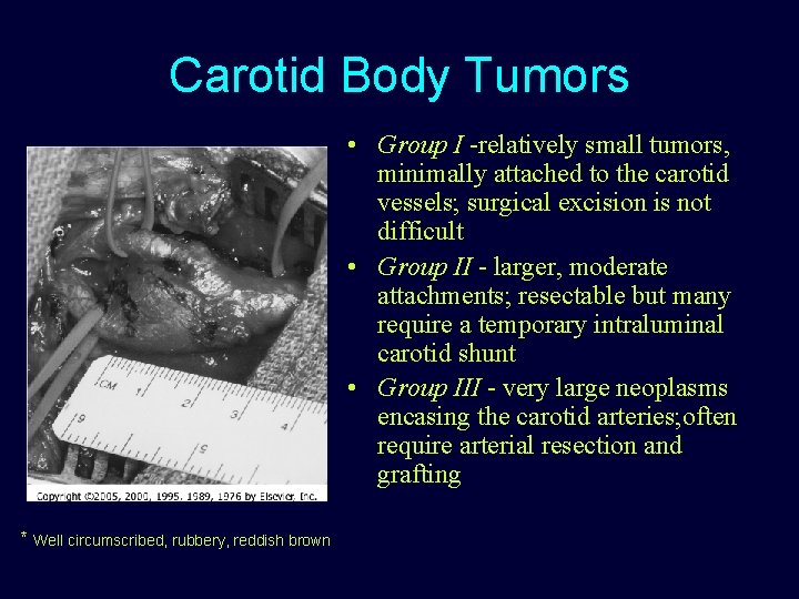 Carotid Body Tumors • Group I -relatively small tumors, minimally attached to the carotid