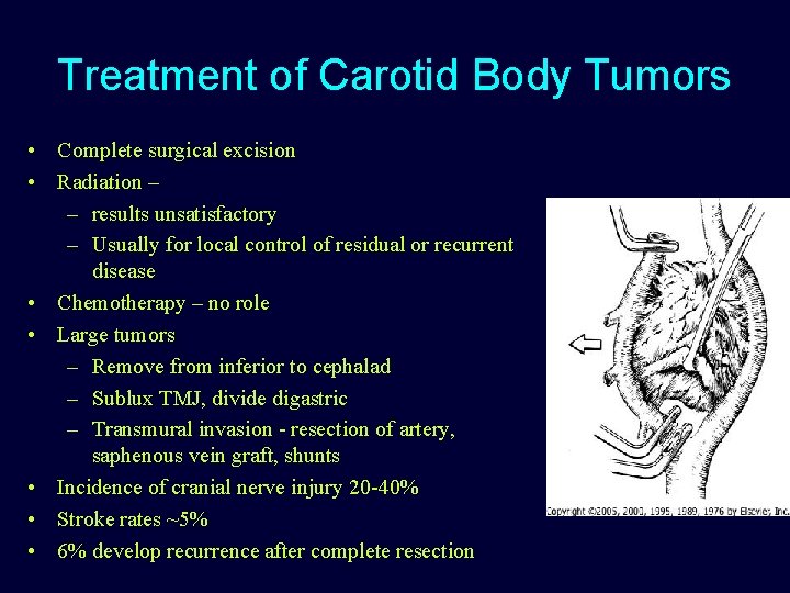 Treatment of Carotid Body Tumors • Complete surgical excision • Radiation – – results