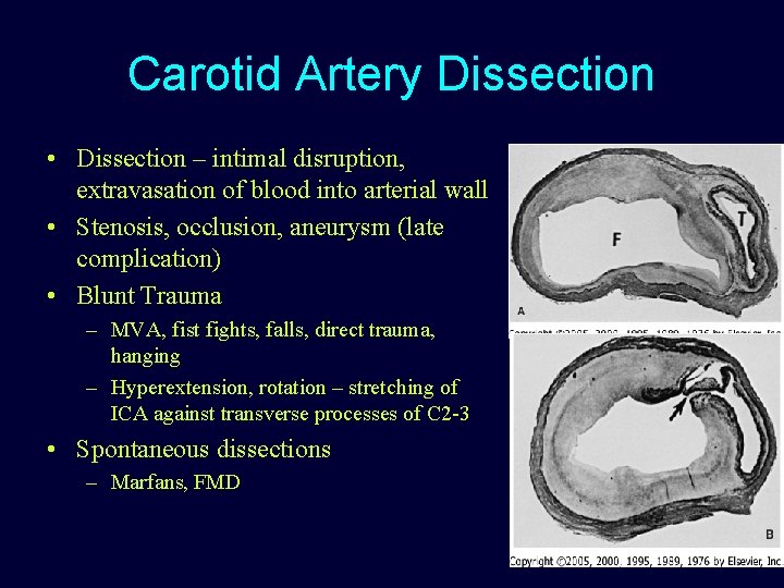 Carotid Artery Dissection • Dissection – intimal disruption, extravasation of blood into arterial wall