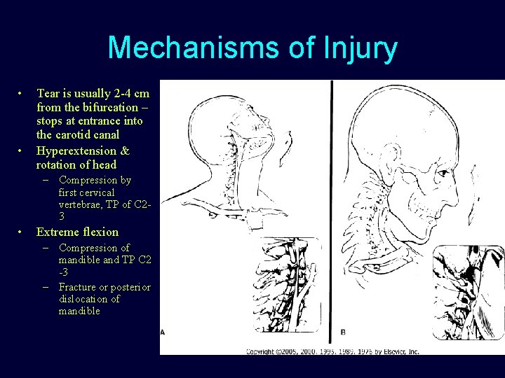 Mechanisms of Injury • • Tear is usually 2 -4 cm from the bifurcation