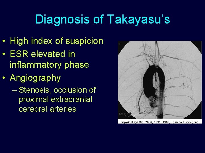 Diagnosis of Takayasu’s • High index of suspicion • ESR elevated in inflammatory phase