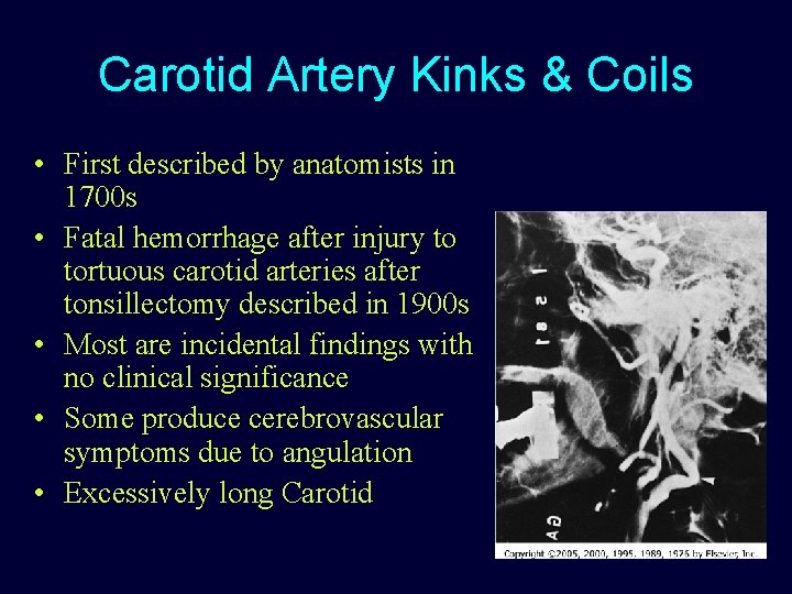 Carotid Artery Kinks & Coils • First described by anatomists in 1700 s •