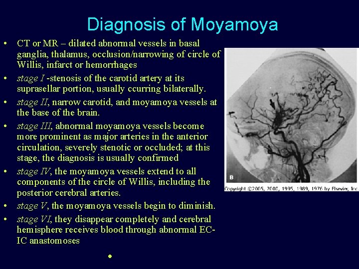 Diagnosis of Moyamoya • CT or MR – dilated abnormal vessels in basal ganglia,