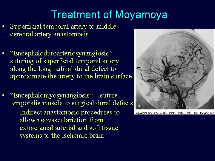 Treatment of Moyamoya • Superficial temporal artery to middle cerebral artery anastomosis • “Encephaloduroarteriosynangiosis”