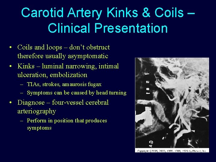 Carotid Artery Kinks & Coils – Clinical Presentation • Coils and loops – don’t