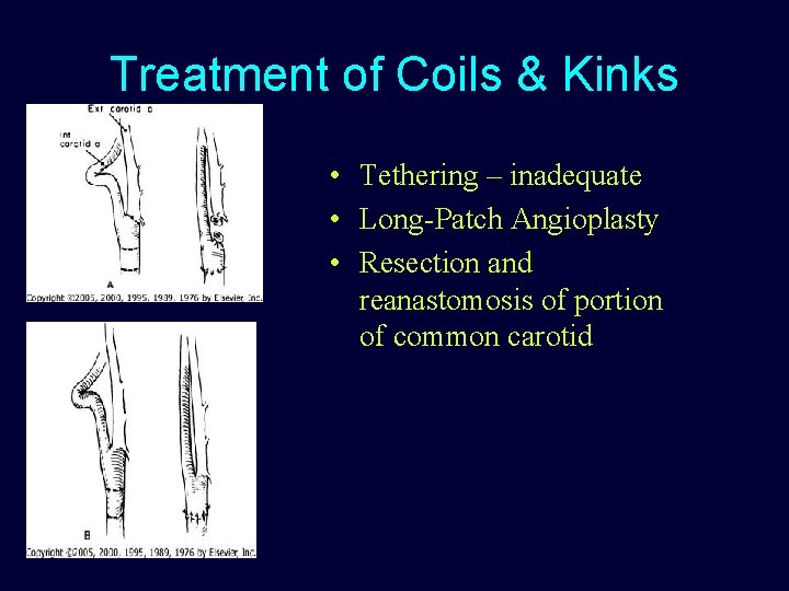 Treatment of Coils & Kinks • Tethering – inadequate • Long-Patch Angioplasty • Resection