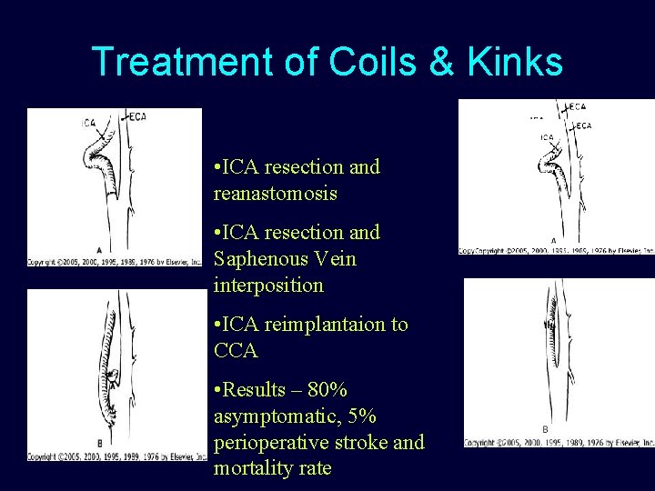 Treatment of Coils & Kinks • ICA resection and reanastomosis • ICA resection and