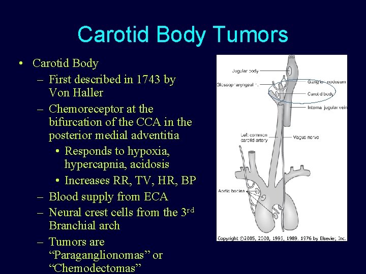 Carotid Body Tumors • Carotid Body – First described in 1743 by Von Haller